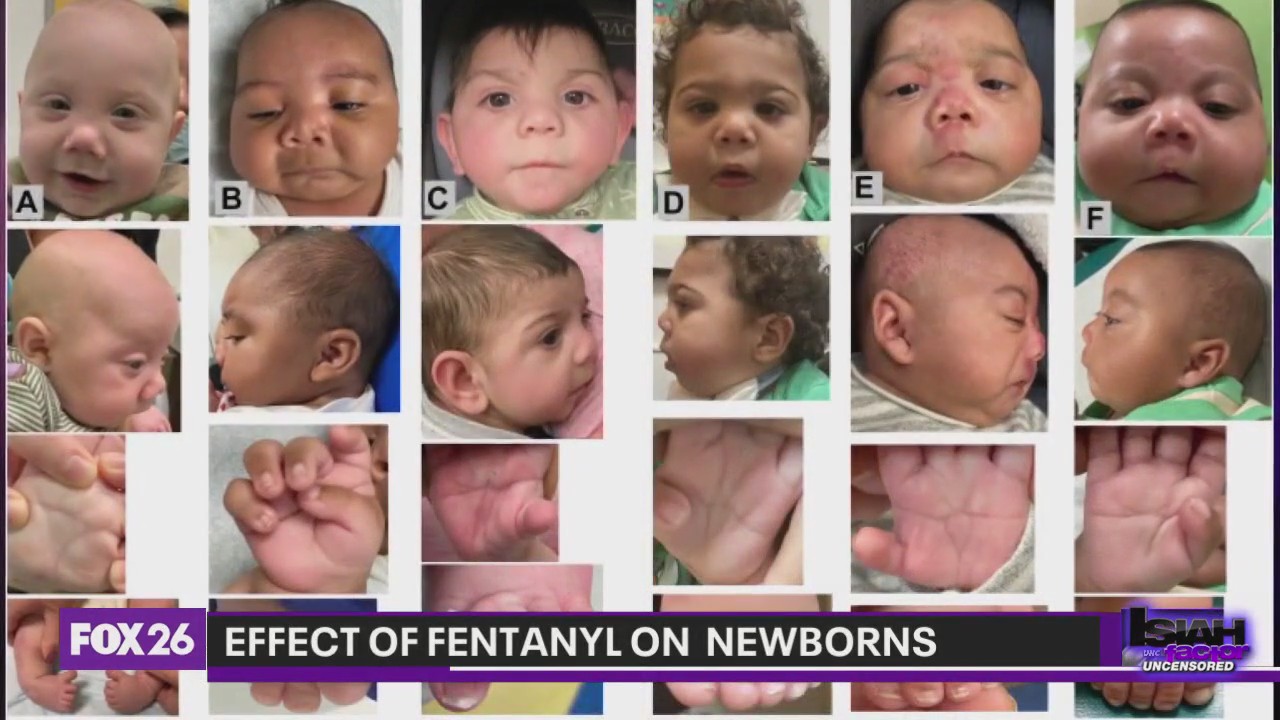 Study: Newborns suffer from birth defects due to fentanyl abuse