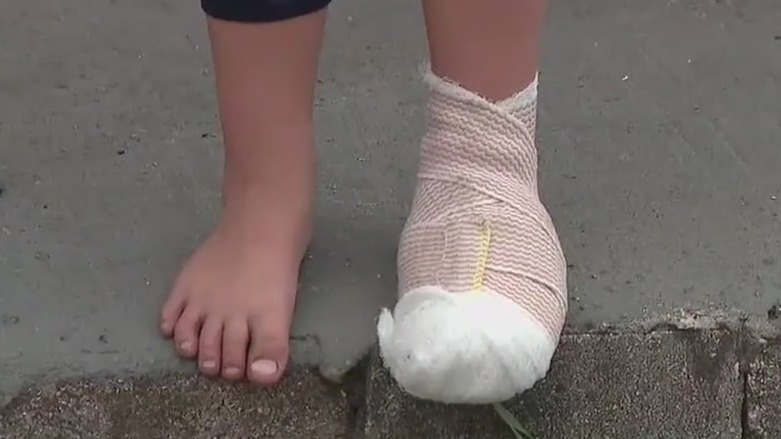 2 kids burned by hot charcoal dumped from grill