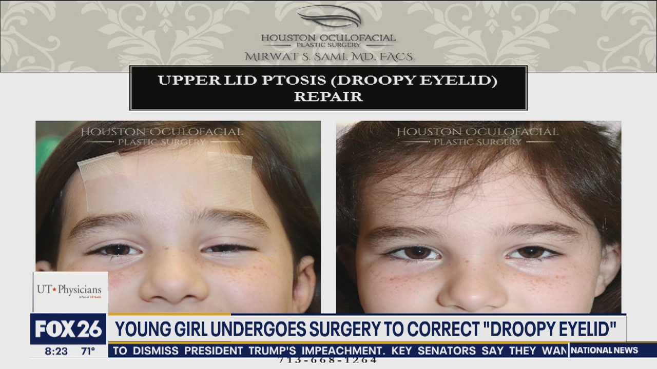 Surgery to correct "droopy eyelid"
