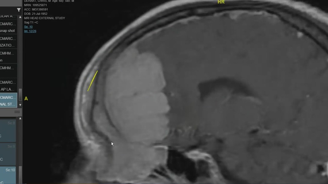 Houston Methodist Hospital teams saves man with gigantic brain tumor