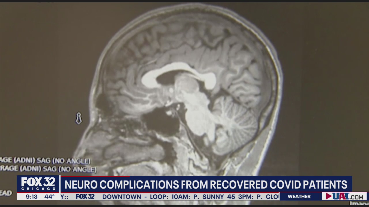 Some COVID 'long-haulers' experiencing neurological issues