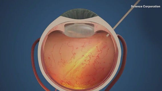 New chip tech helps restore sight for patients