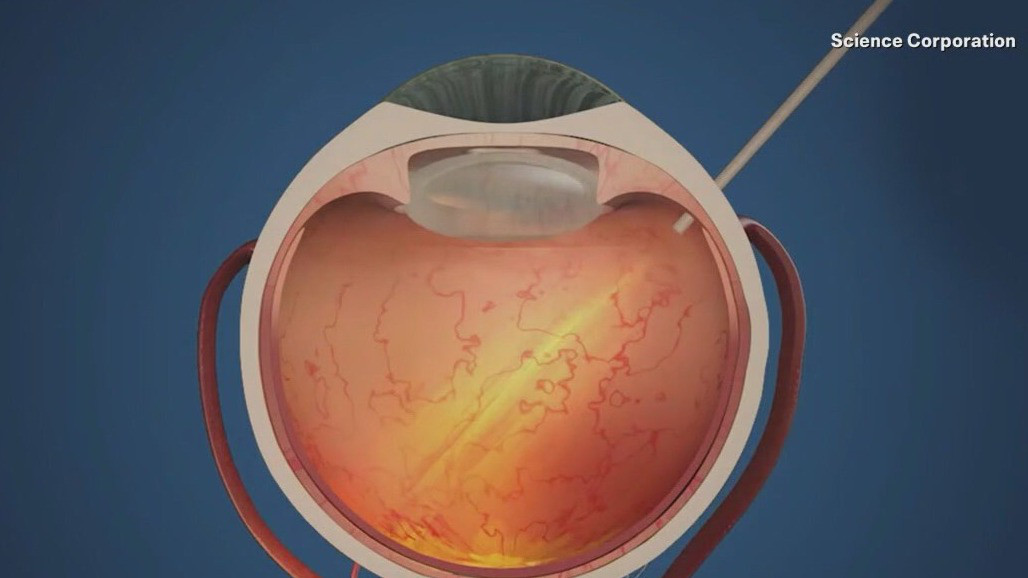 New chip tech helps restore sight for patients