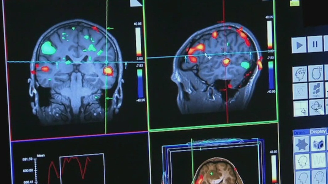 Stressful jobs may protect against Alzheimer's