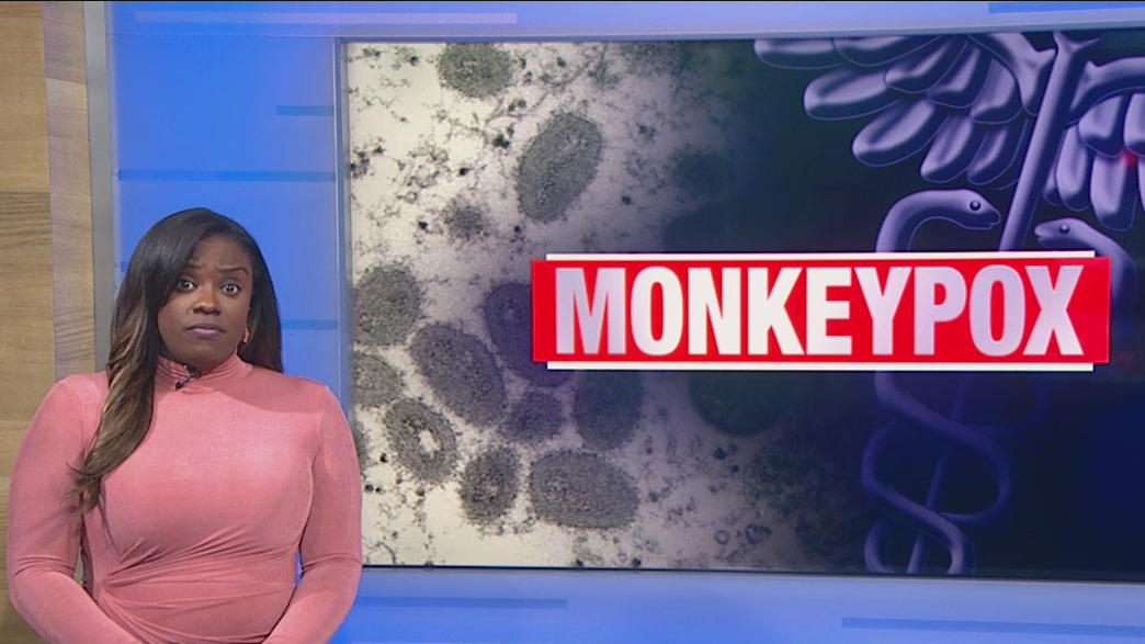 U of I prepares to fight the spread of monkeypox