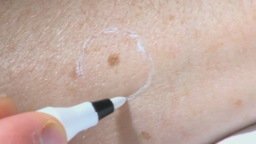 Health watch: Be on the lookout for signs of skin cancer