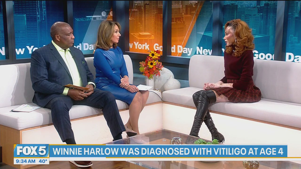 Winnie Harlow's inspirational impact on vitiligo awareness