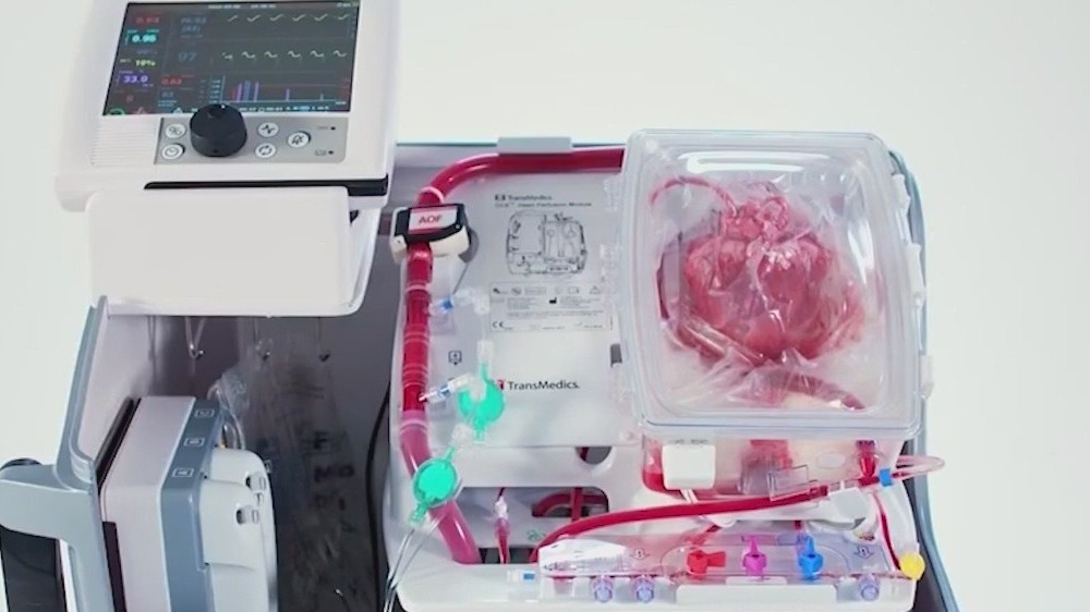 Chicago surgeons successfully transplant heart from donor whose heart stopped beating