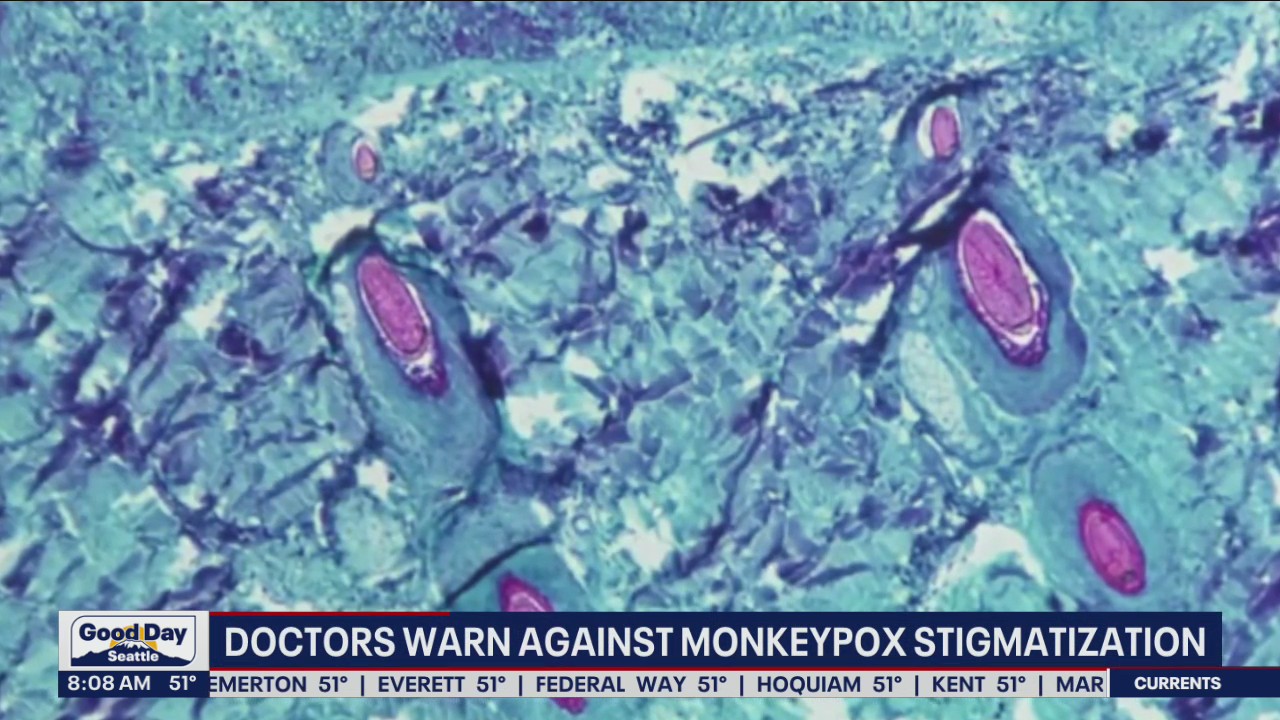 Doctors warn against monkeypox stigmatization