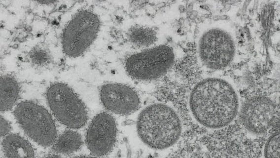 Monkeypox cases rising in Chicago; Biden declares public health emergency