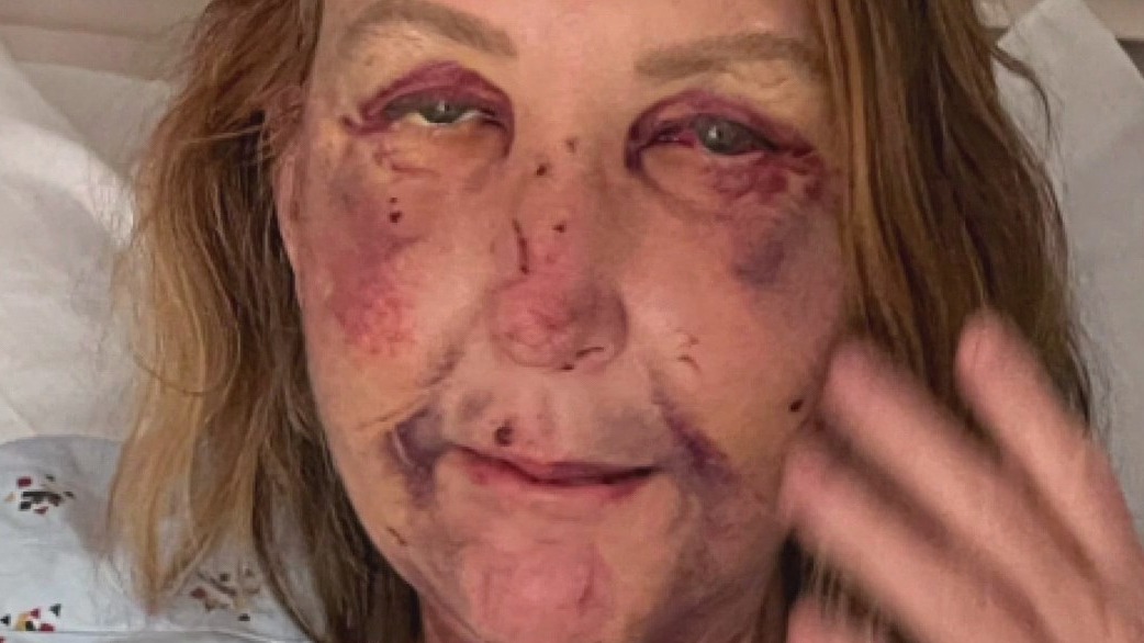 Woman viciously attacked in Venice