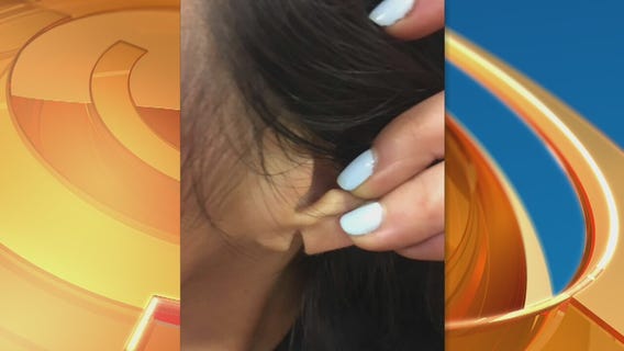 Torn earlobe? Doctor discusses procedure to fix it