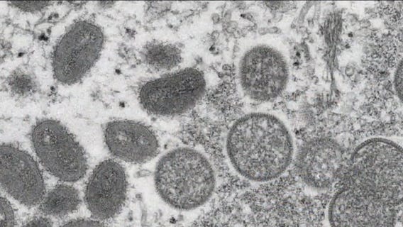 Rising mpox cases prompt concern from medical officials