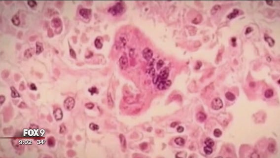 Measles cases spread outside Hennepin County