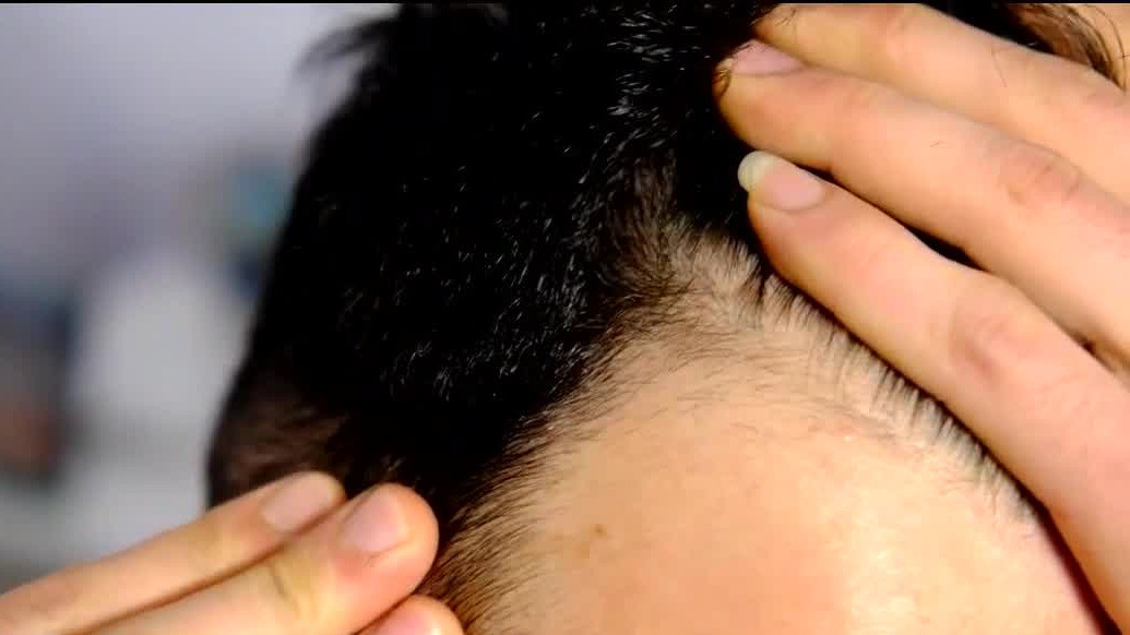 Can onion juice stop hair loss?