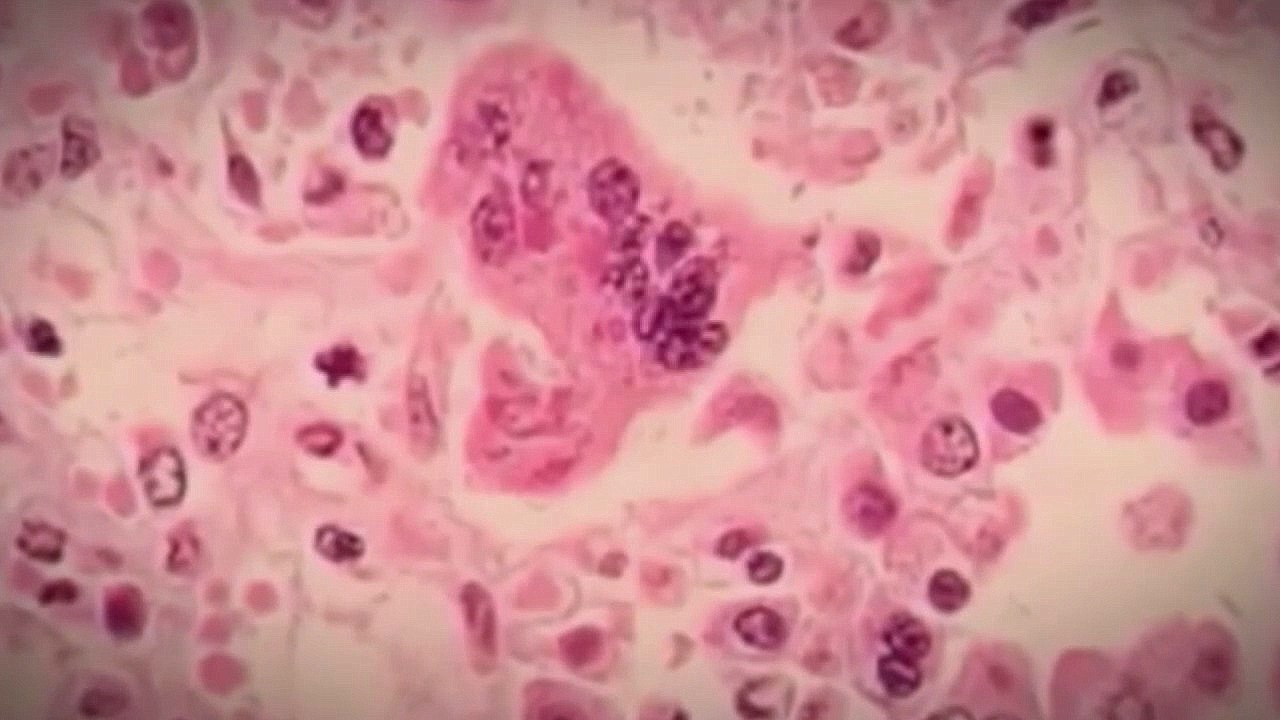 4th measles case confirmed in Michigan, 2nd in Washtenaw County