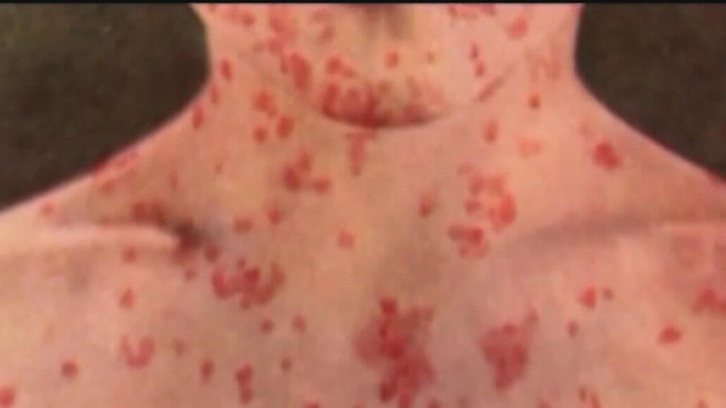 Texas measles outbreak: Spike in new cases
