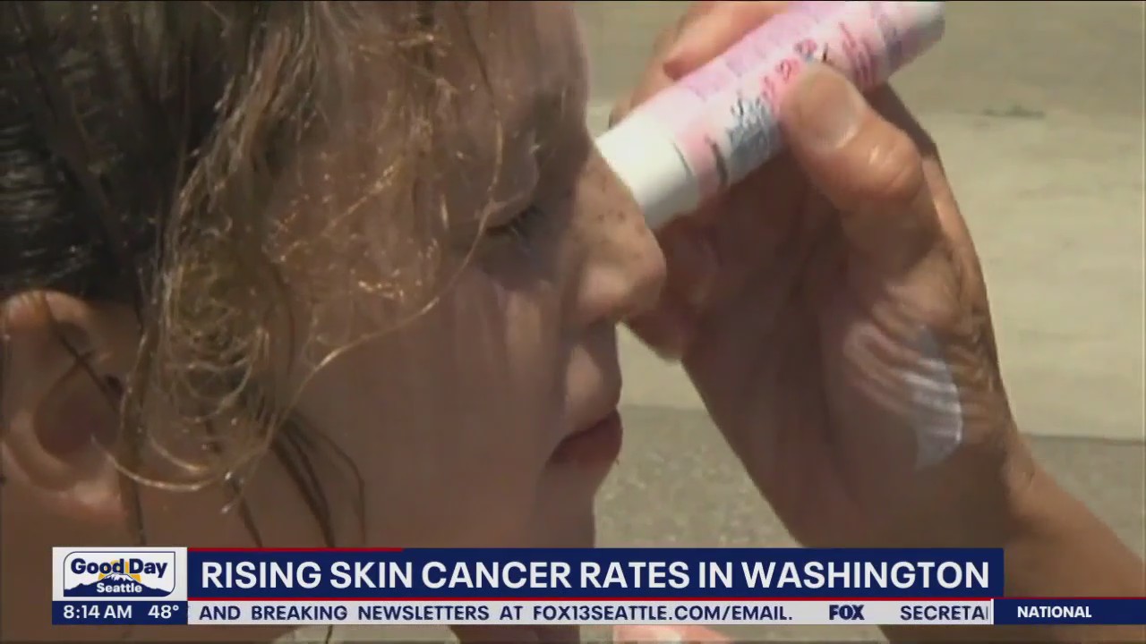 Rising skin cancer rates in Washington