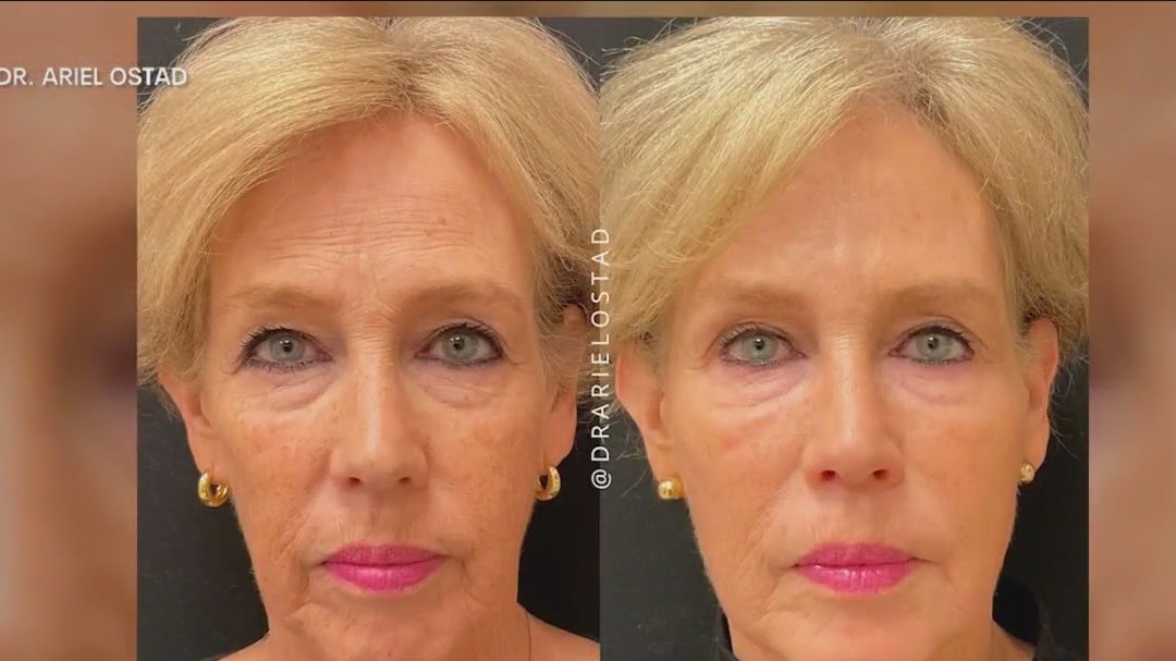 Liquid facelifts: Here's why they are trending
