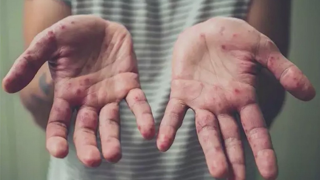 As school year approaches, health leaders increase focus on kids amid monkeypox outbreak