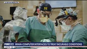 U-M Health doctors test brain computer chips to treat incurable conditions