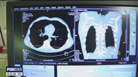 The Doctor Is In: Early detection of lung cancer saves lives
