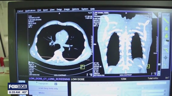The Doctor Is In: Early detection of lung cancer saves lives