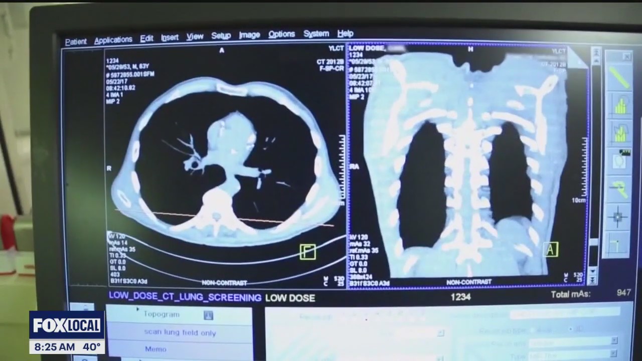 The Doctor Is In: Early detection of lung cancer saves lives