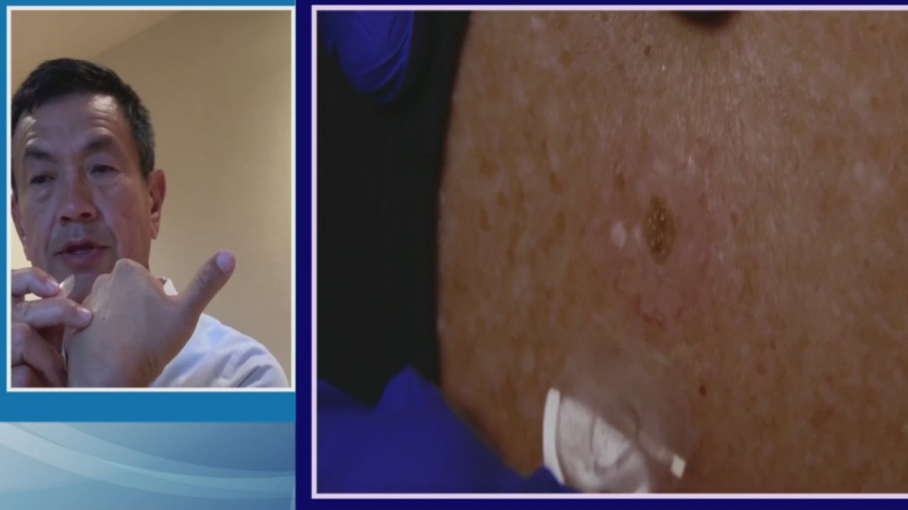 New technology can detect melanoma cancer cells without a scalpel