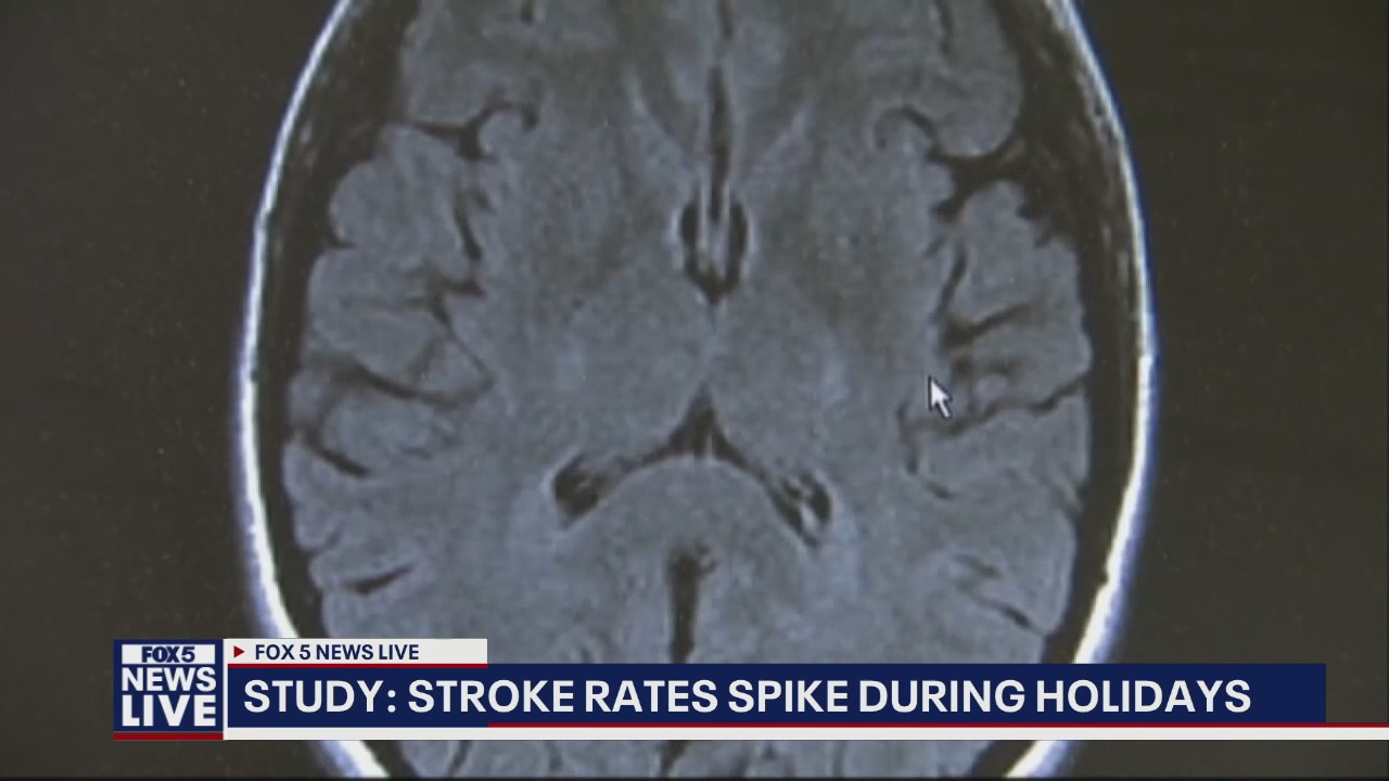 Study says stroke rates spike during the holidays