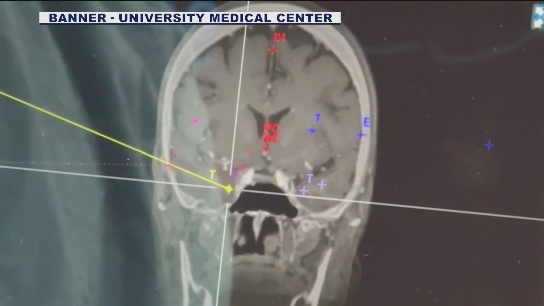 Robotic surgery could help epilepsy patients