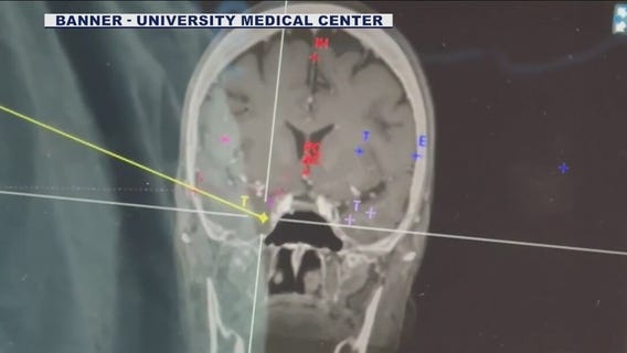 Robotic surgery could help epilepsy patients