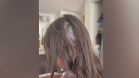 Child grazed by stray bullet