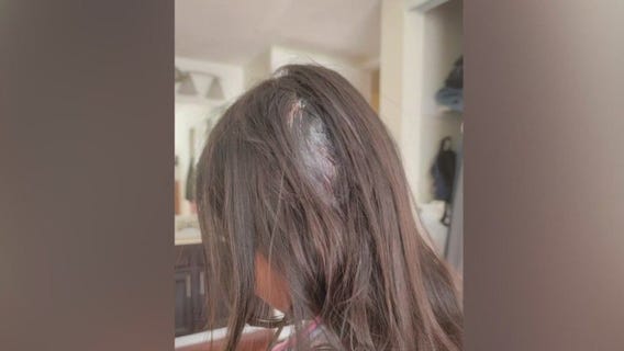 Child grazed by stray bullet