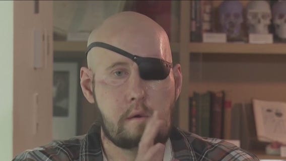 First human eye transplant