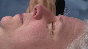 Spring allergy sufferers turn to needle treatment for natural relief