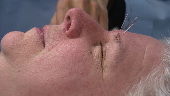 Spring allergy sufferers turn to needle treatment for natural relief