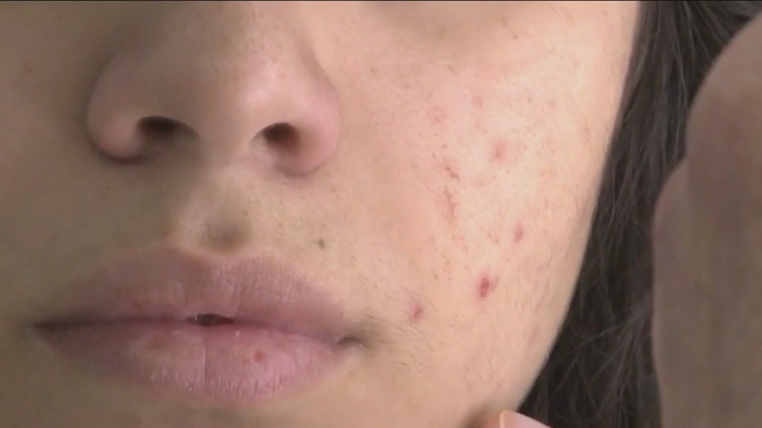 Pre-teen skincare routines doing more harm than good