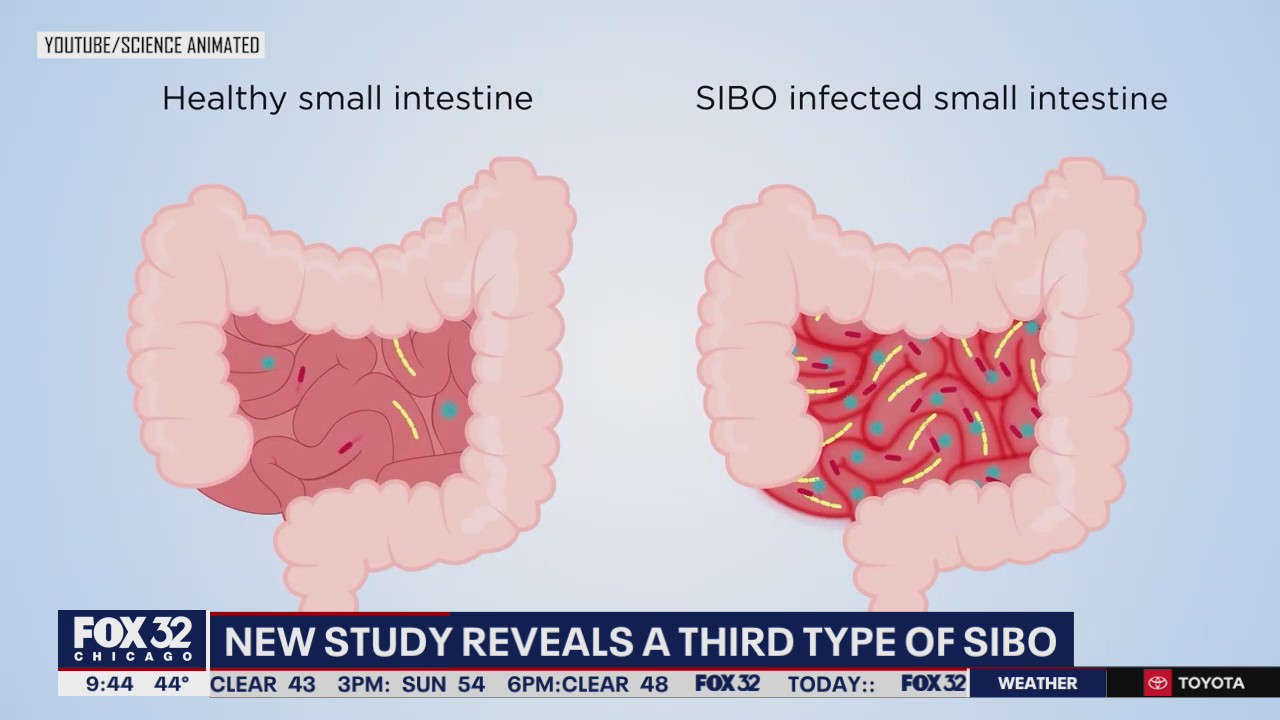 New study reveals a third type of SIBO: Here's what that means for your gut health