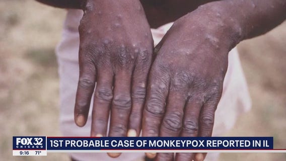 First probable case on monkeypox detected in Illinois