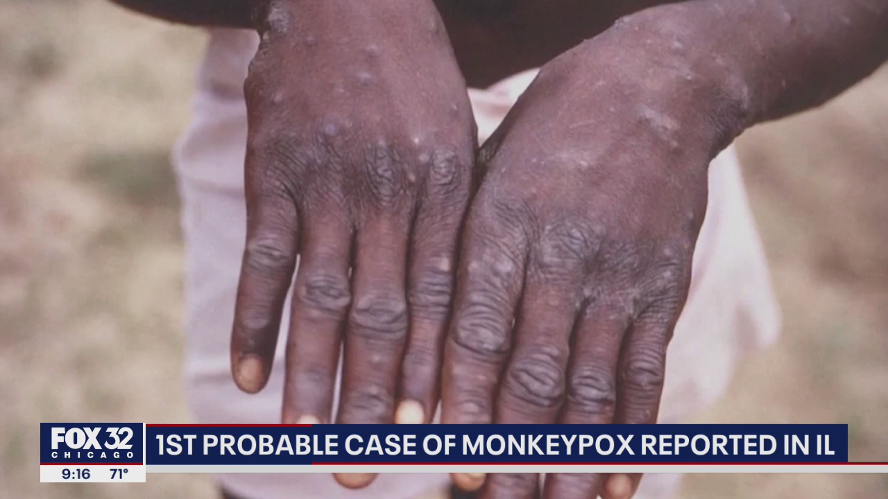 First probable case on monkeypox detected in Illinois