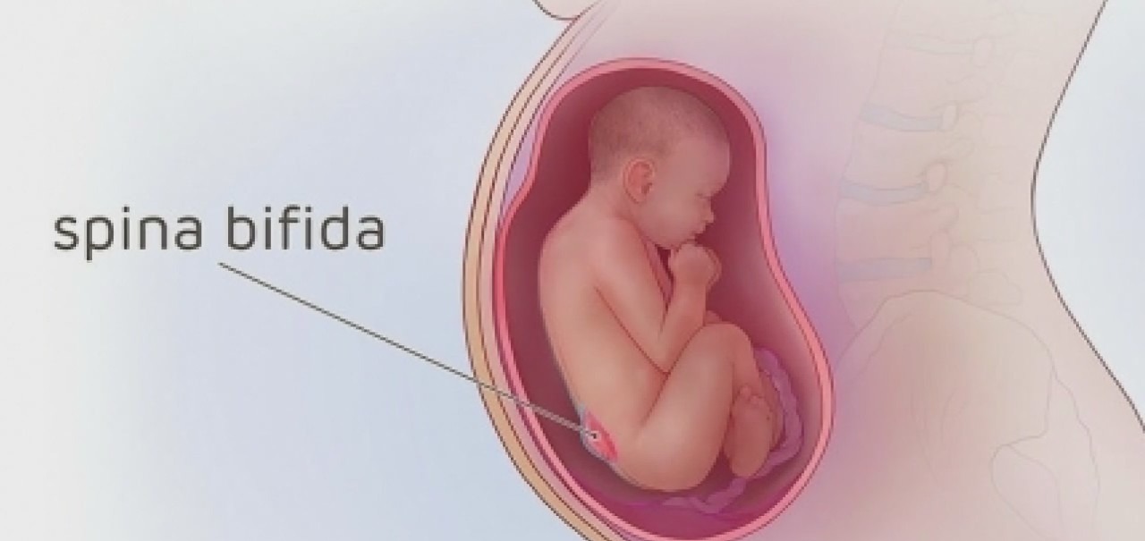 Family hoping breakthrough Spina Bifida procedure will help 'miracle baby'