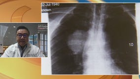 Study shows more people are surviving cancer