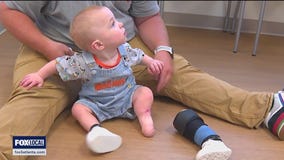 Twin amputee adjusts to new prosthetic