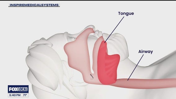 There are many ways to treat sleep apnea - including by implant