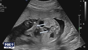 St. Paul family welcomes healthy baby boy after successful in utero surgery