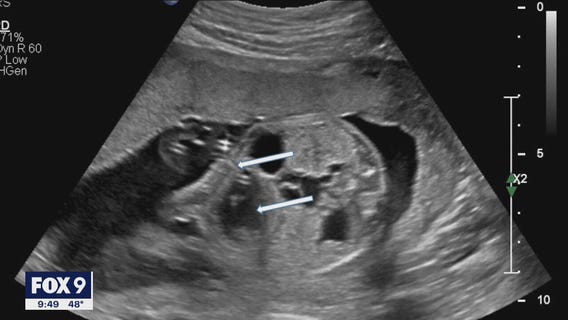 St. Paul family welcomes healthy baby boy after successful in utero surgery