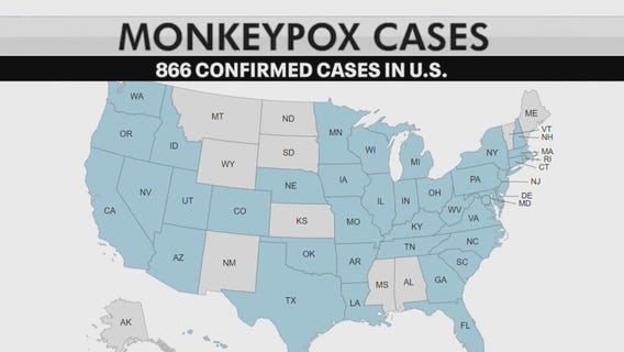 Monkeypox: 1st case in Milwaukee resident, health officials say