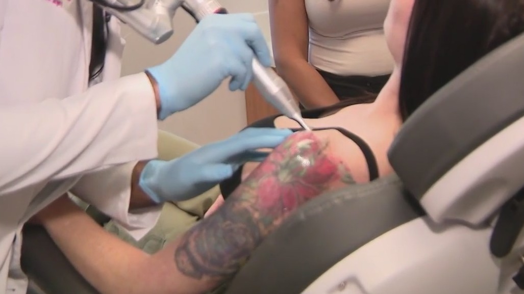 Pico laser in Phoenix being used for tattoo removal