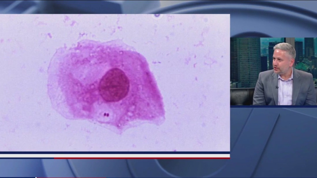 NYC Dept. Health warn meningitis cases are rising